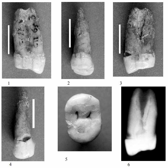 Boccard premolar