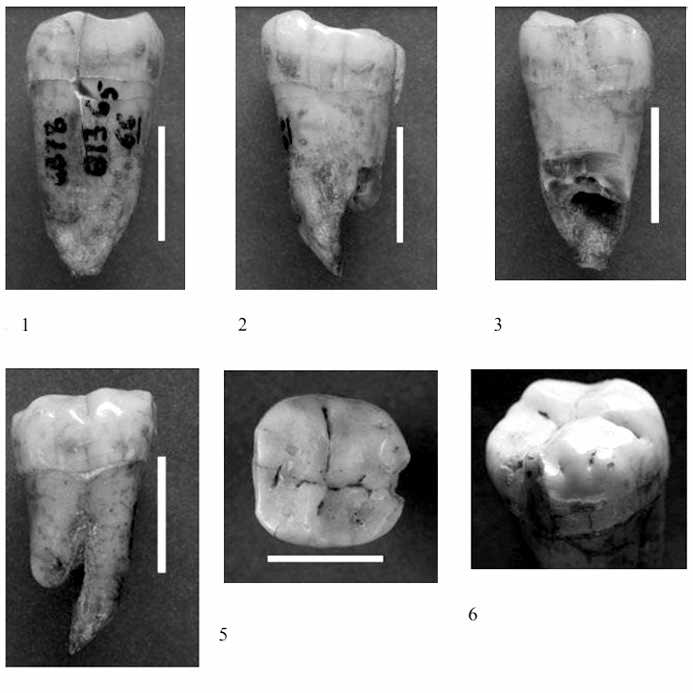 Boccard molar