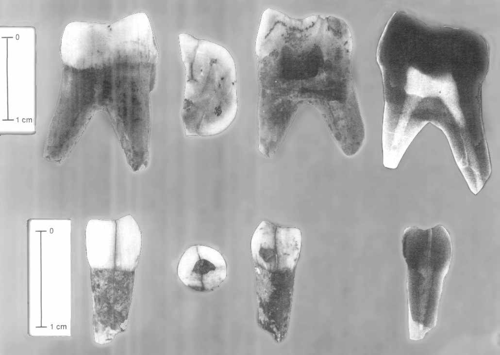 Molar Baume Neuron