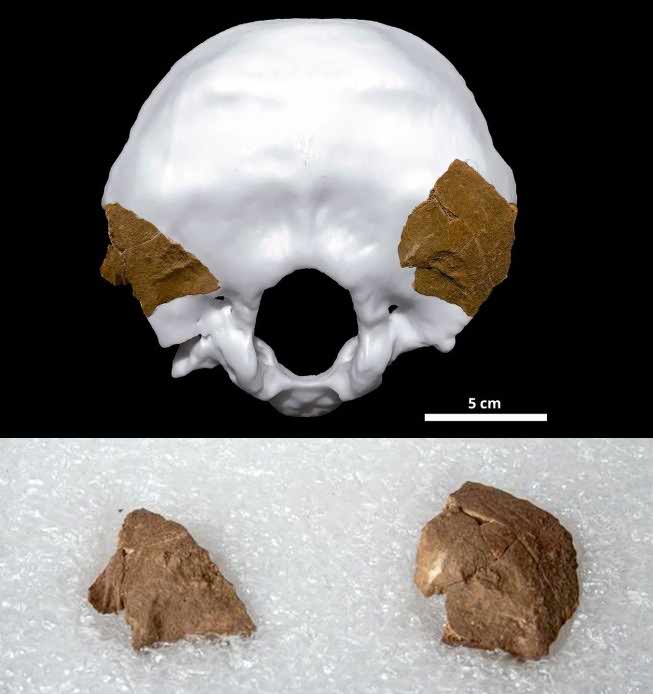 Teixoneres occipital bones